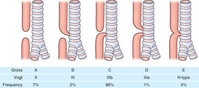 Eosinophilic Esophagitis in Esophageal Atresia